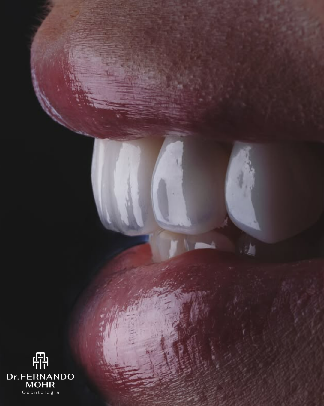 Caso 2 — Lentes Dentais