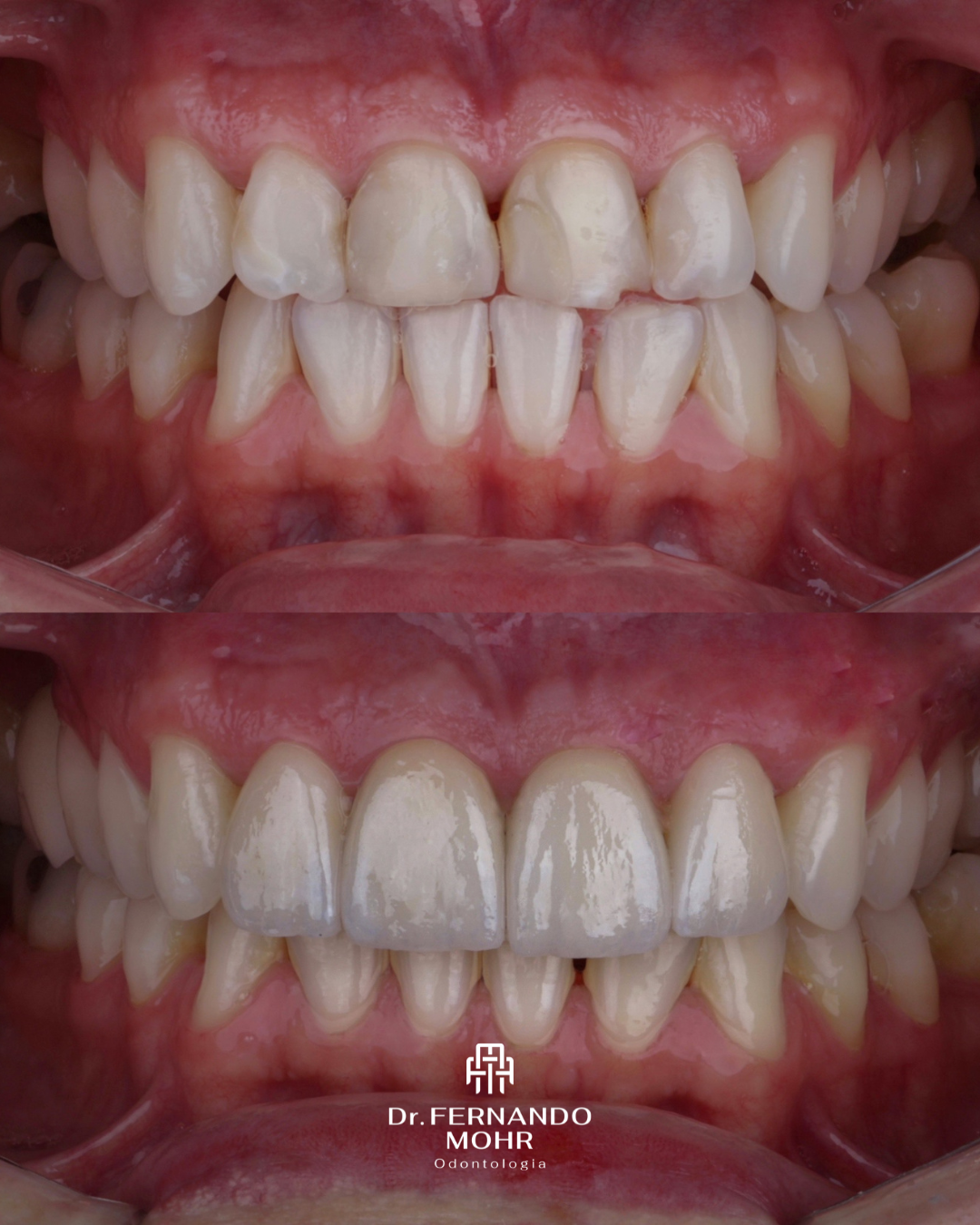 Caso 6 — Lentes Dentais